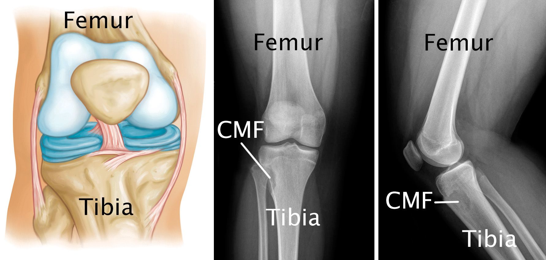 x-rays of a chondromyxoid fibroma