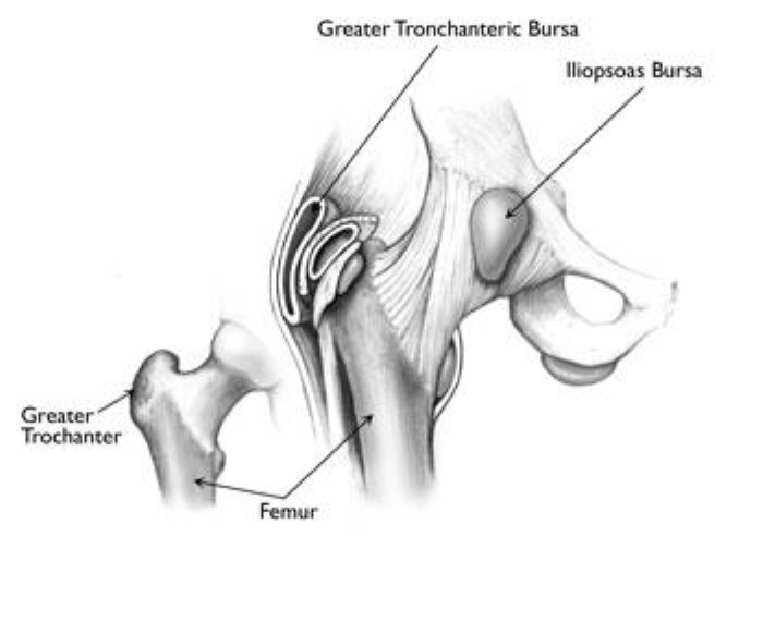 Hip Bursitis - OrthoInfo - AAOS