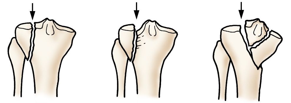 Illustration of tibia fractures that enter the knee joint
