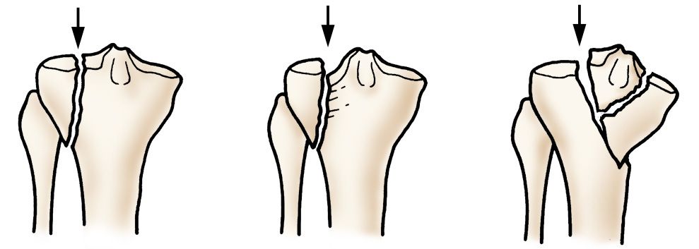 Fractures Of The Proximal Tibia Shinbone Orthoinfo Aaos