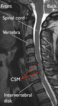 MRI scan of a herniated disk