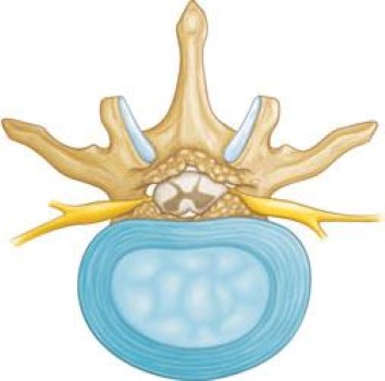 Bone spurs narrowing the spinal canal