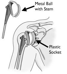 Total shoulder joint replacement