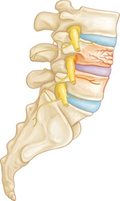 Compression fracture of the lumbar spine. 