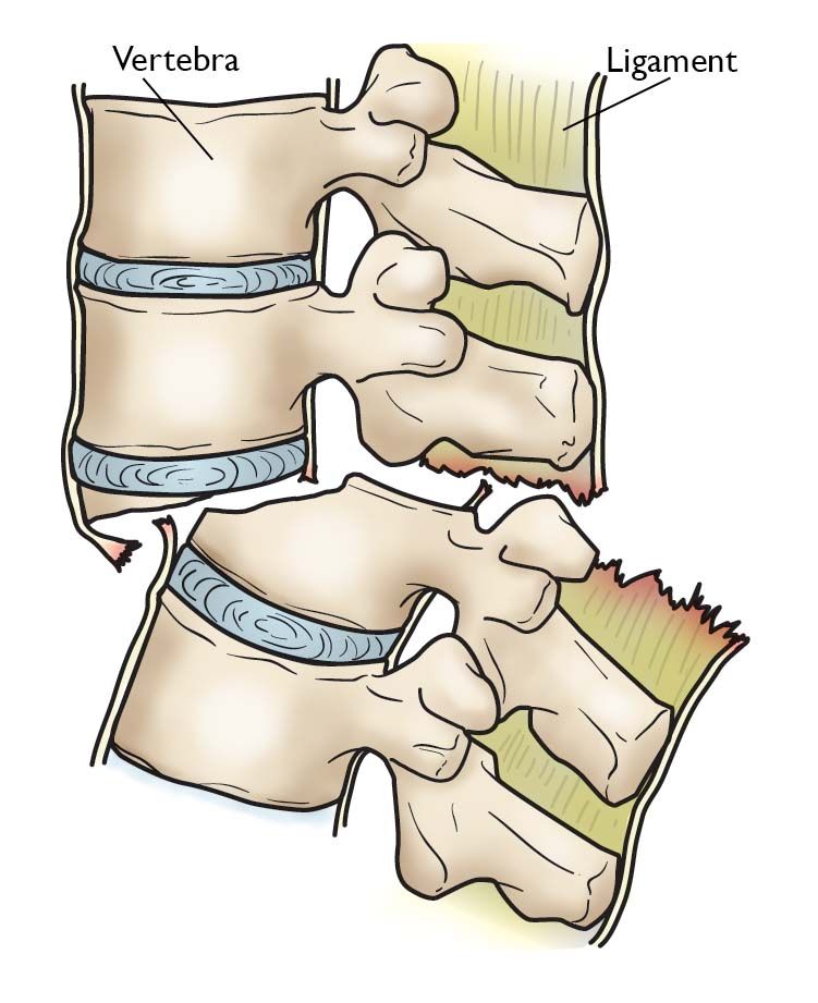 Side view of a fracture-dislocation of a thoracic vertebra. 