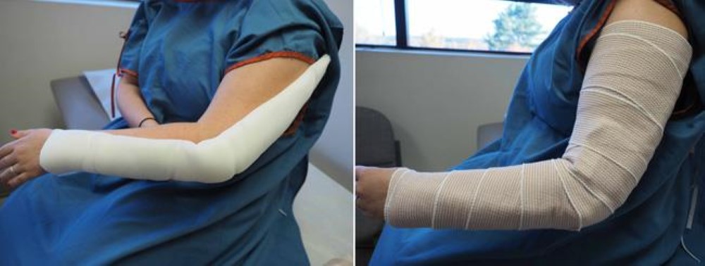 elbow fracture cast