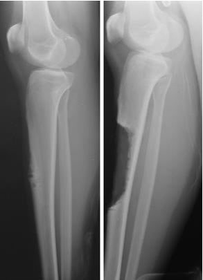 adamantinoma before and after limb salvage