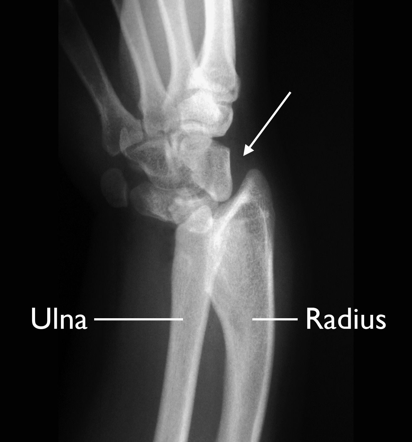 X-ray of Madelung deformity