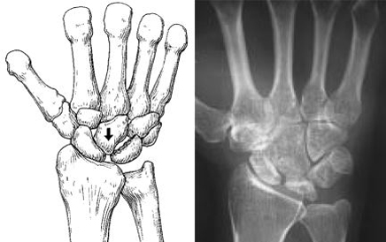 Kienböck's disease stage 3