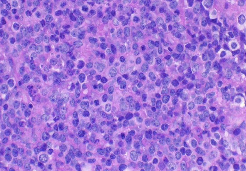 Microscopic view of lymphoma cells