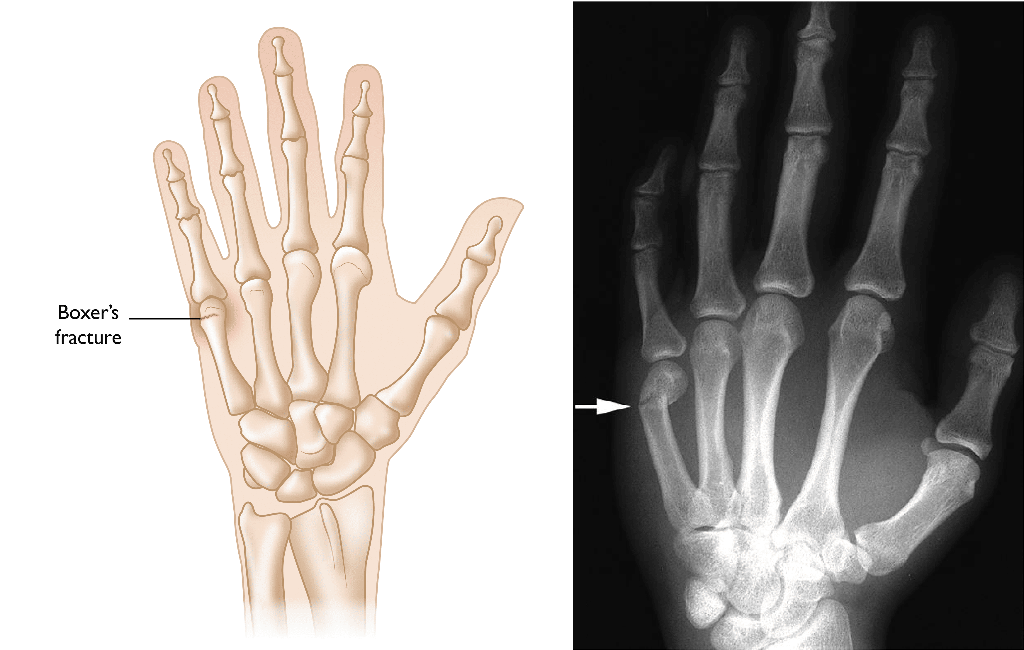 Xray Broken Finger