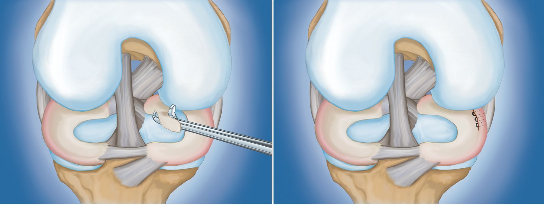 Meniscus Tears OrthoInfo AAOS